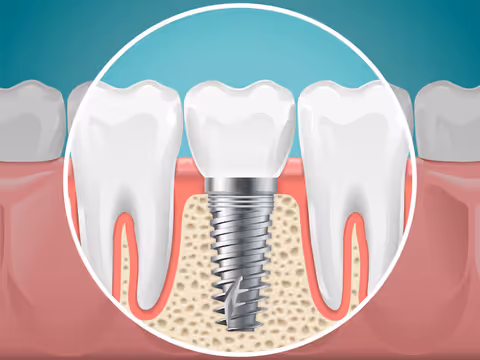 Dental Implants Overview for Long-Term Dental Solutions