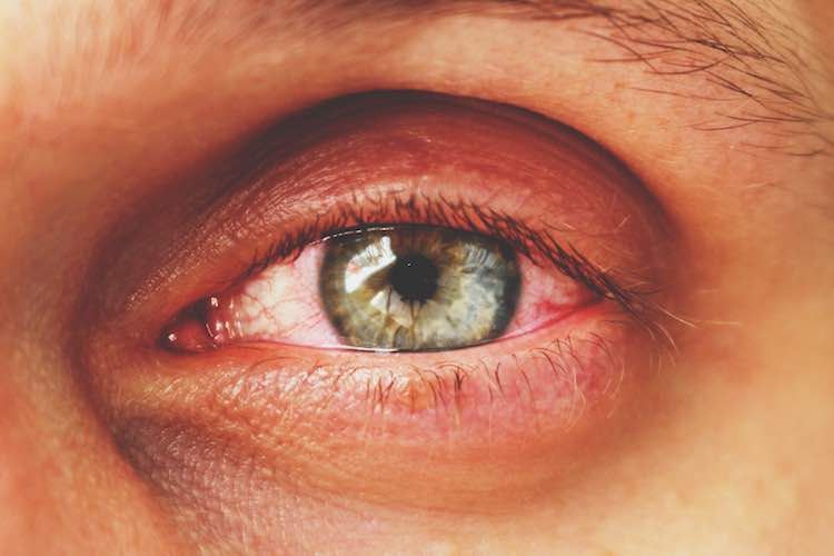 Thyroid Eye Disease 